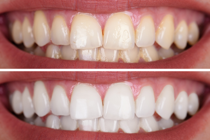 Whitening_1196509231